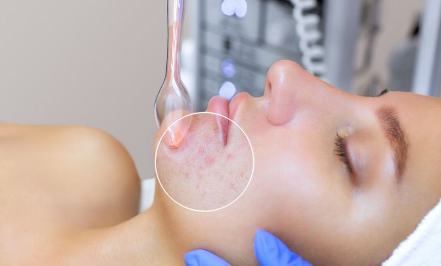 Image 8: Up to 51% Off on Acne Facial at Skin Deep Beauty and Beyond