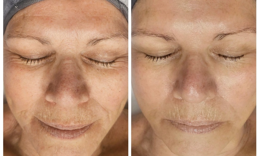 Image 6: Up to 31% Off on HydraFacial at Phoenix Esthetics of CT
