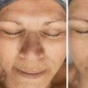 Image 6: Up to 31% Off on HydraFacial at Phoenix Esthetics of CT