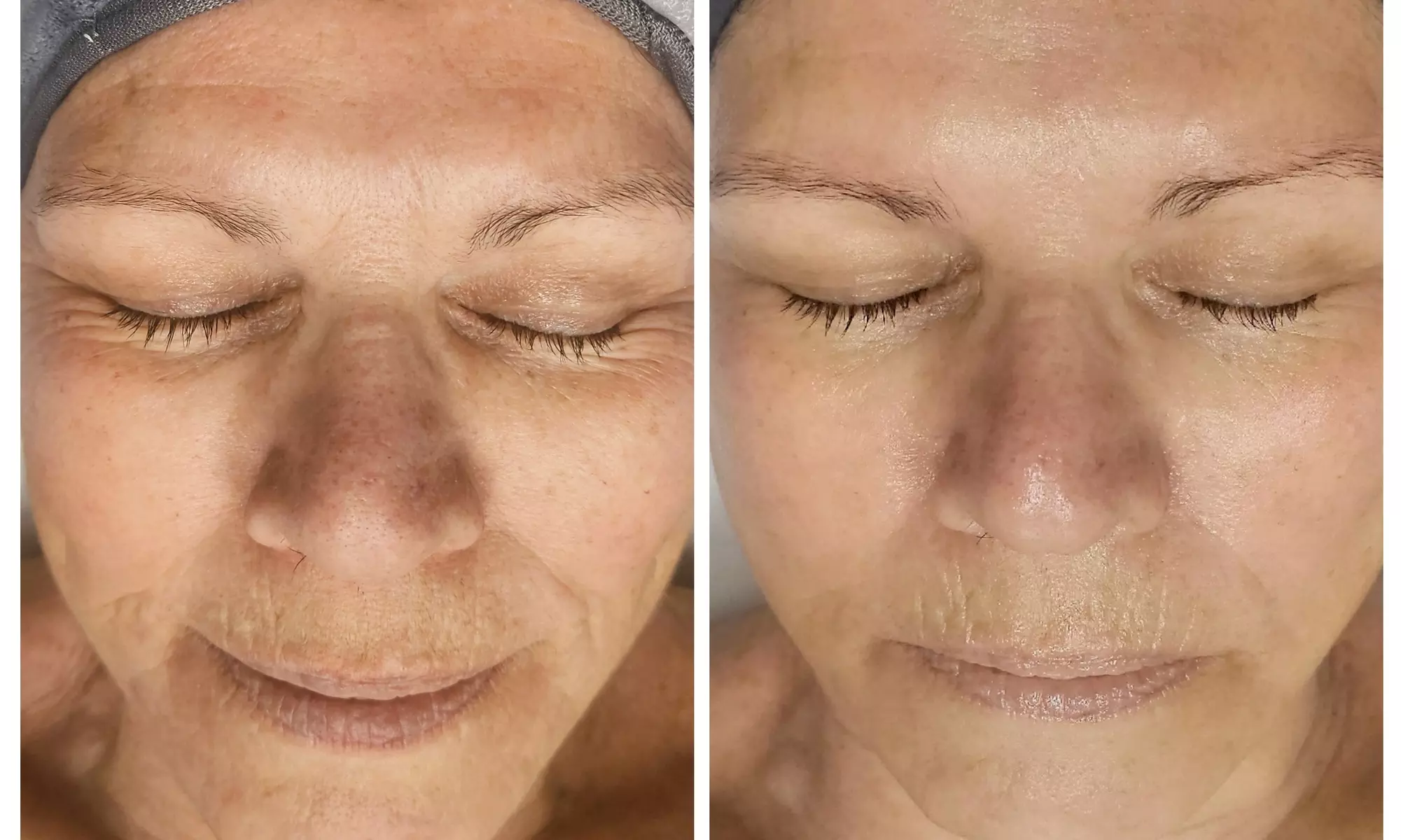 Up to 40% Off on HydraFacial at Phoenix Esthetics of CT