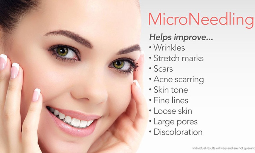 Image 3: Up to 53% Off on Micro-Needling at My Aesthetic Lounge