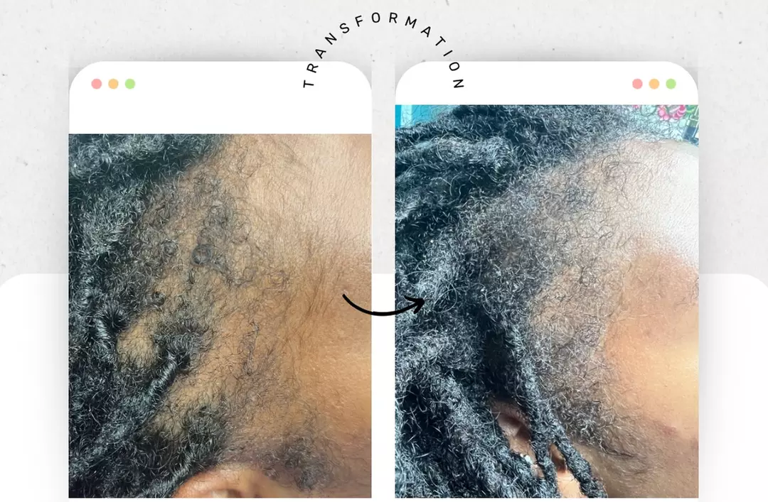 Up to 45% Off on Hair Restoration - Non-Surgical at Aesthetics Care Med Spa