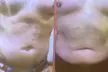 Transform Your Body with Two or Four Laser Liposuction Sessions at Bellissimo You and Save Up To 64% - Second Medium