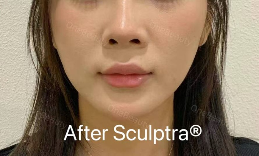 Image 3: 35% Off Sculptra or Radiesse at One Beauty Aesthetics
