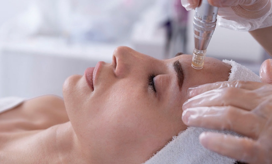 Image 2: Bis zu 50% Rabatt auf Micro-Needling bei Glow Spot