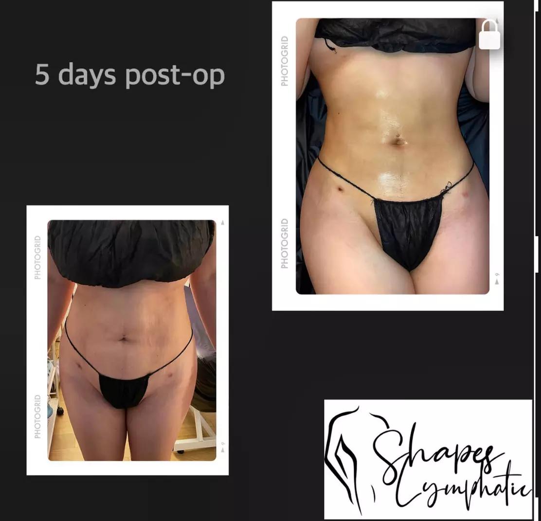 Up to 53% Off on Lymphatic Drainage Massage at Shapes Lymphatic - Primary Image
