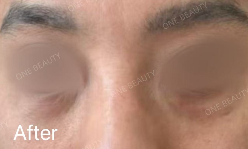 Image 6: Up to 71% Off on Vampire Facelift at One Beauty Aesthetics