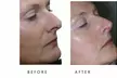 Face-Slim – Non-Invasive Facial Fat Reduction & Contouring at Your Sculpt Studio in Washington, DC - Second Medium