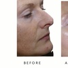 Image 3: Face-Slim – Non-Invasive Facial Fat Reduction at Your Sculpt Studio DC