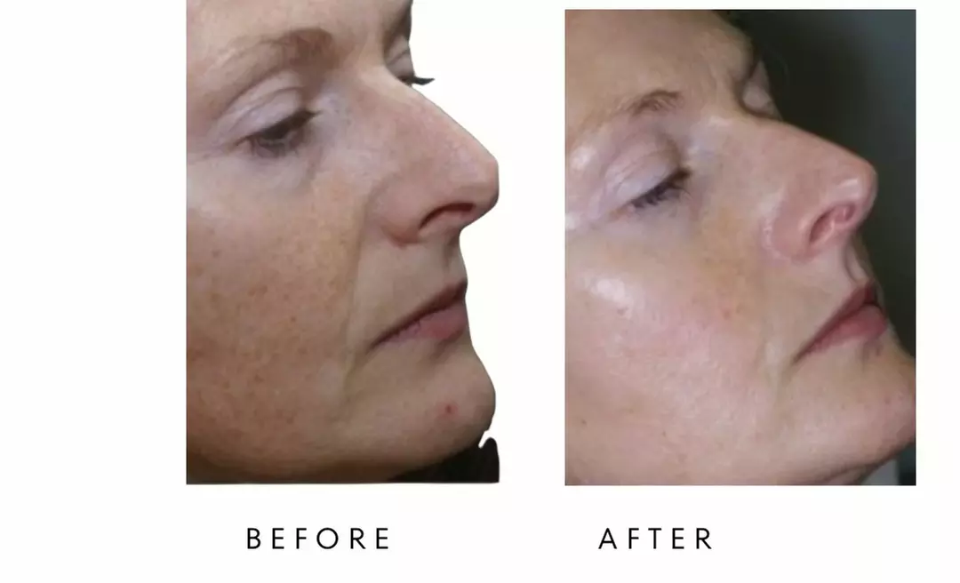 Face-Slim – Non-Invasive Facial Fat Reduction at Your Sculpt Studio DC