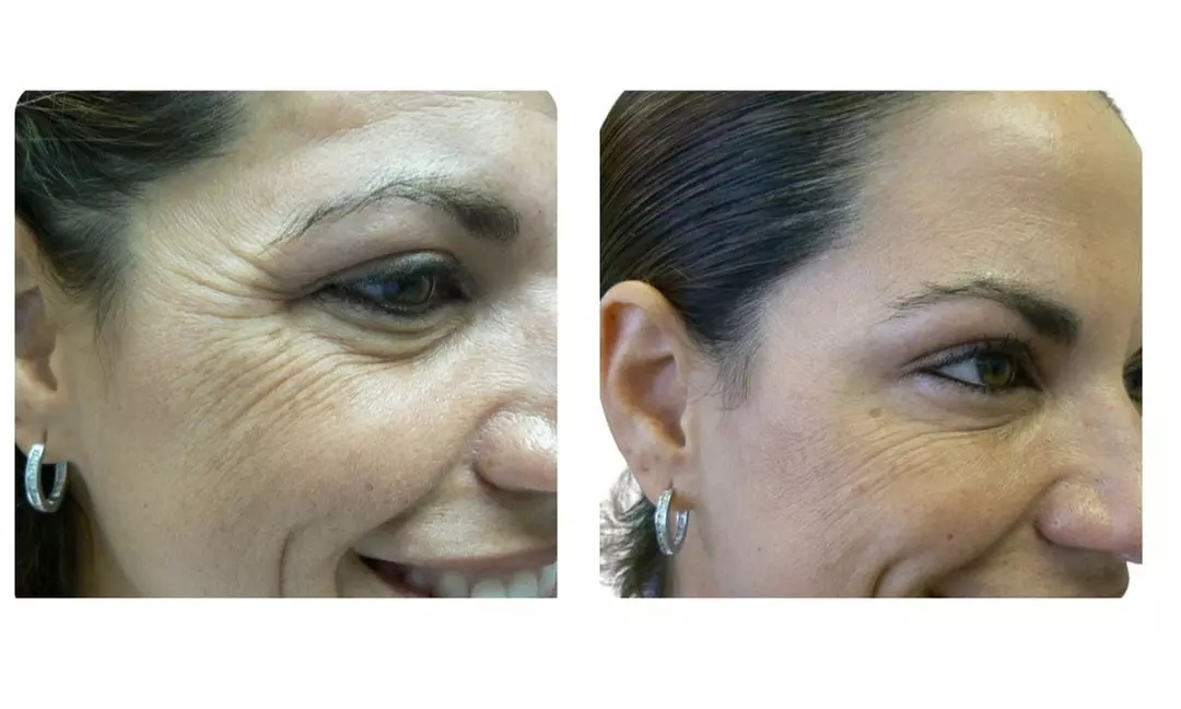 Refresh Yourself with Xeomin Shots