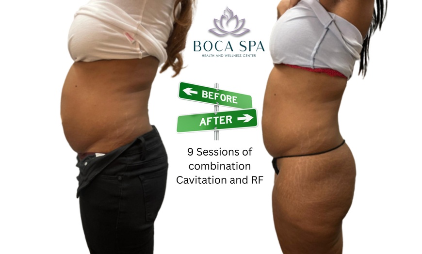 Image 5: Three, Six or Nine Sessions of VelaShape