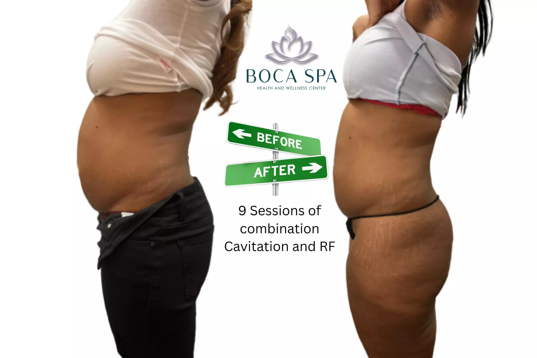 Three, Six or Nine Sessions of VelaShape