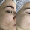 Image 4: Up to 70% Off on Facials at Euphoria Aesthetics