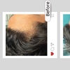 Image 1: Up to 49% Off on Hair Restoration - Non-Surgical at Aesthetics Care Med Spa
