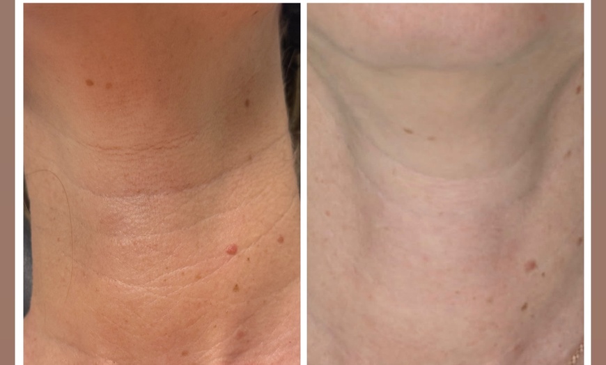 Image 2: Revitalize Your Skin with BBGlow, Chemical Peel, or Microneedling