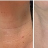 Image 2: Revitalize Your Skin with BBGlow, Chemical Peel, or Microneedling