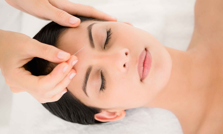 Image 2: Up to 50% Off on Acupuncture at Doris DWQC Acupuncture PC