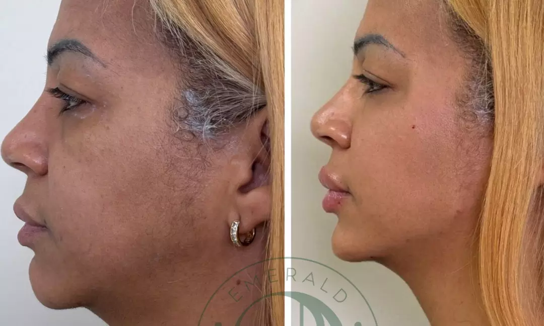 Luxe filler- of botoxbehandeling bij Emerald Aesthetic Clinic