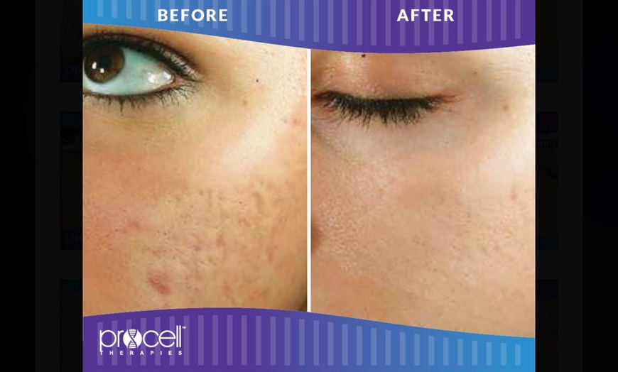 Image 6: Rejuvenate: Procell Therapies: Face & Neck or Stretch Marks & More