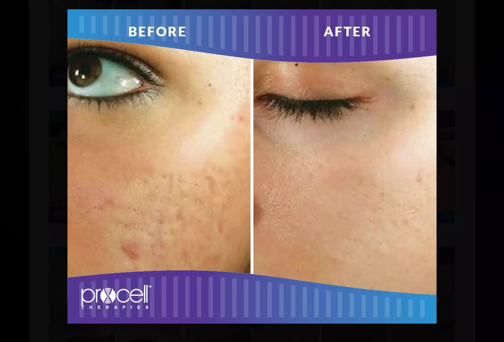 Rejuvenate: Procell Therapies: Face & Neck or Stretch Marks & More