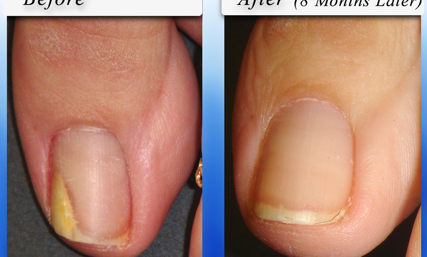 Image 3: Medical Pedicure, Callus Reduction or Nail Fungus Consultation
