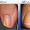 Image 3: Medical Pedicure, Callus Reduction or Nail Fungus Consultation

