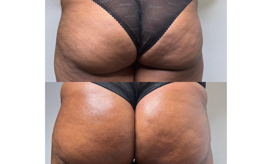 Image 3: Boost Your Confidence with 30, 60, or 90-Minute Non-Invasive Butt Lift