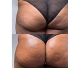 Image 3: Boost Your Confidence with 30, 60, or 90-Minute Non-Invasive Butt Lift