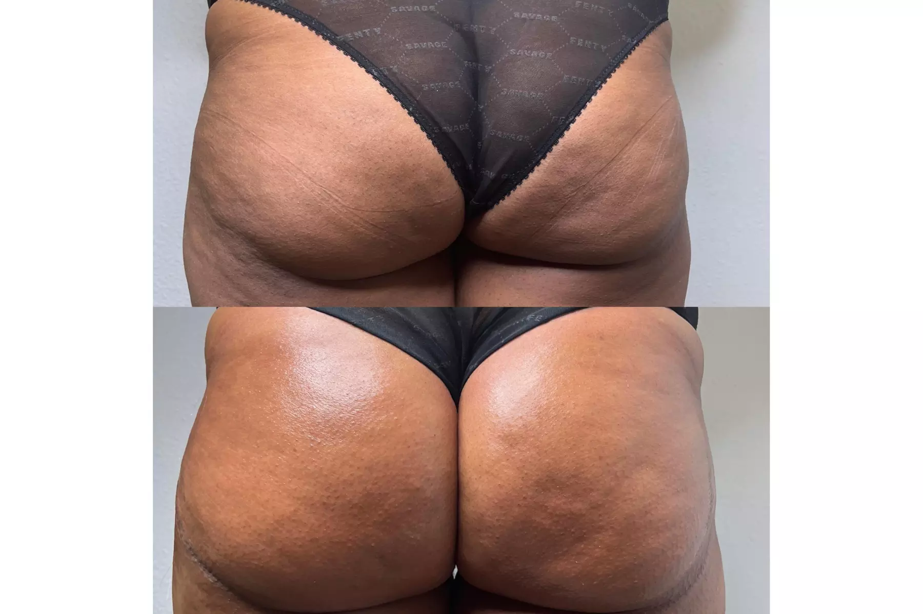 Boost Your Confidence with 30, 60, or 90-Minute Non-Invasive Butt Lift