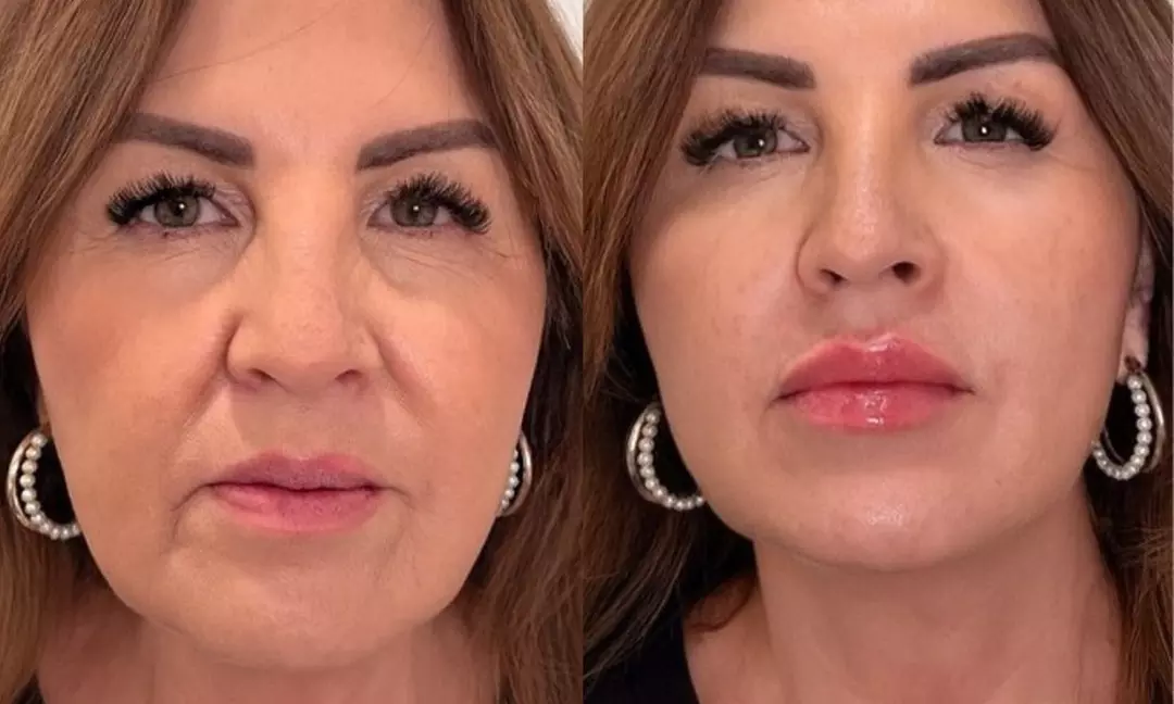 Enhance Your Lips with Russian Lip Enhancement Treatment