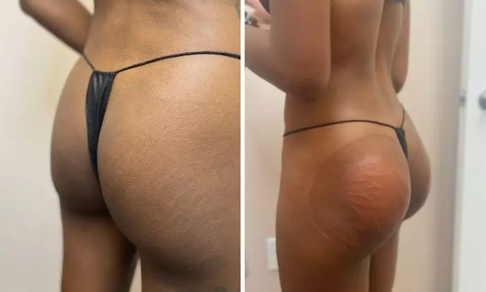 Up to 41% Off on Non-Surgical Butt Lift at Snatched Waxing and Skincare - Primary Image