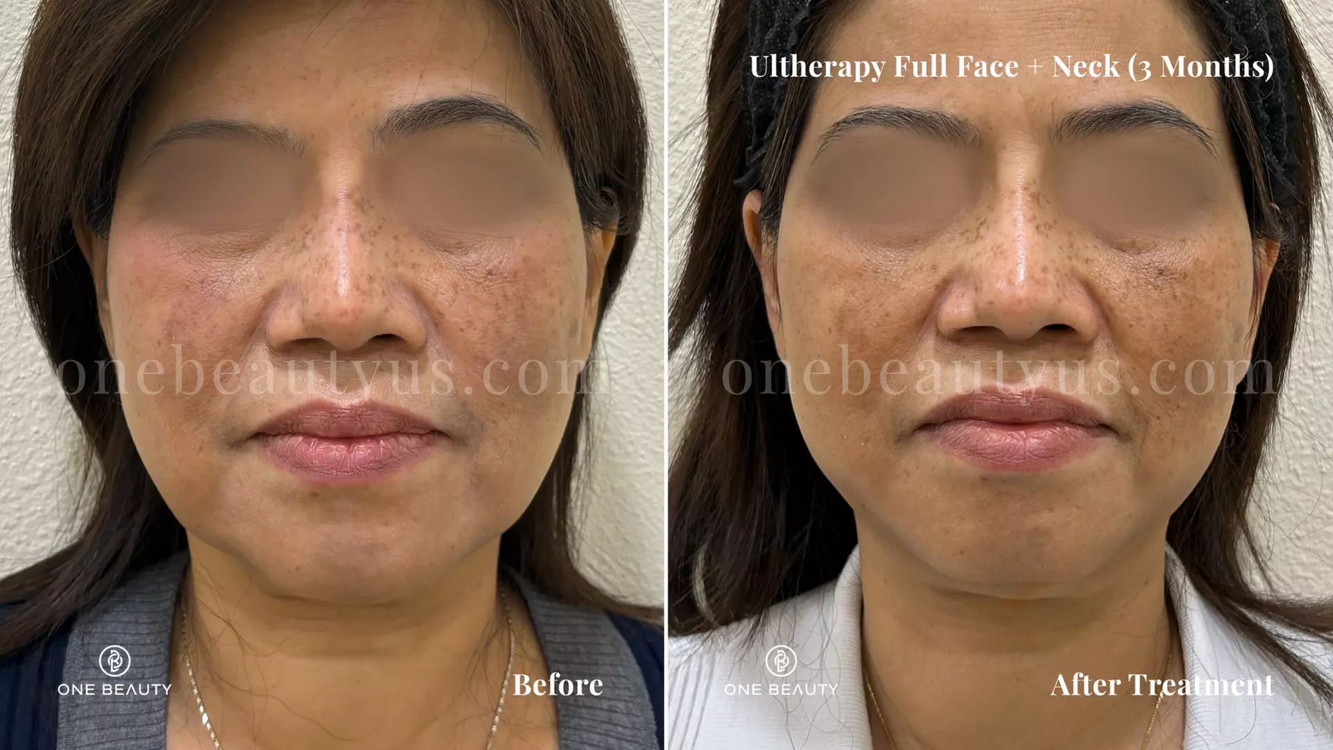 Ultherapy / Ultrasonic Facial at One Beauty Aesthetics