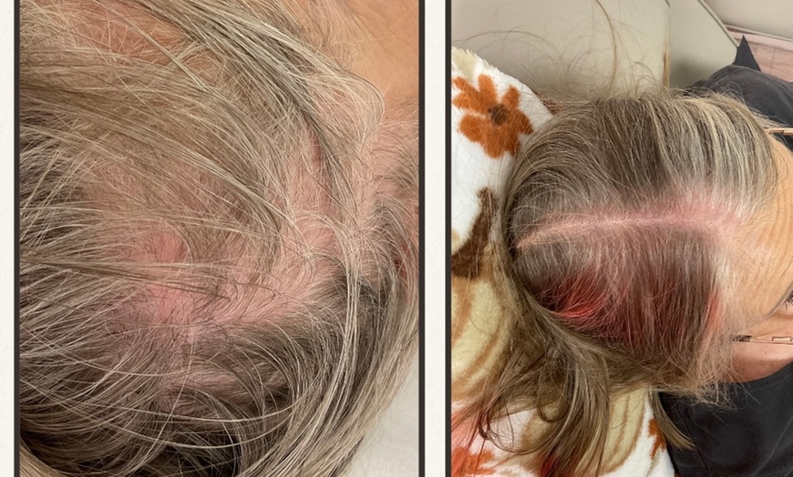 Image 3: Hair Restore Treatment PRP + Microneedling, Exosomes & Celluma Light
