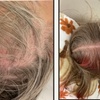 Image 3: Hair Restore Treatment PRP + Microneedling, Exosomes & Celluma Light