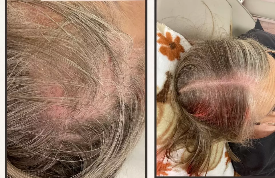 Hair Restore Treatment PRP + Microneedling, Exosomes & Celluma Light