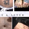 Image 1: Up to 60% Off on Tattoo Removal at Skintastic Aesthetics Treatments