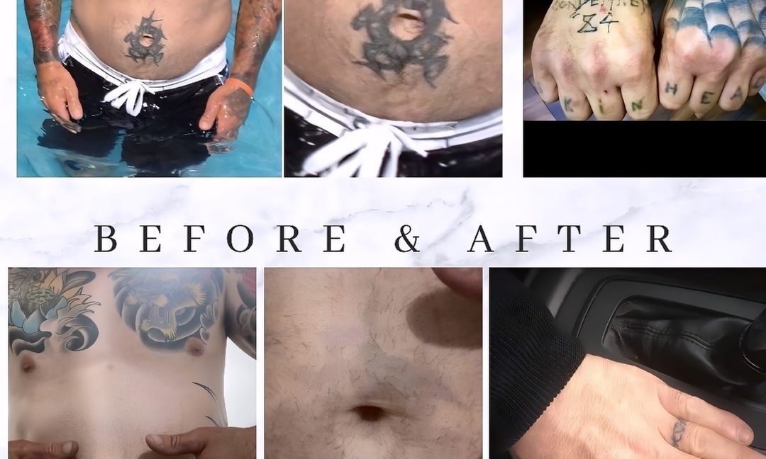 Up to 60% Off on Tattoo Removal at Skintastic Aesthetics Treatments