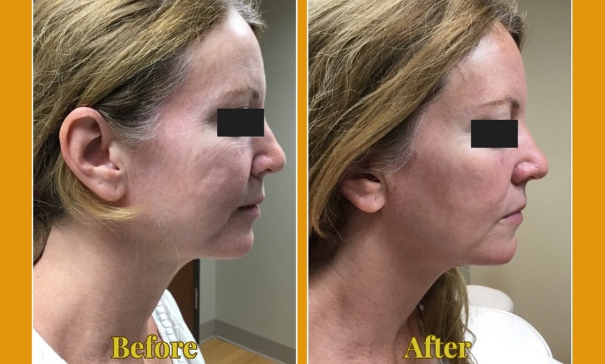 Image 2: Ultherapy Prime Treatment with for Face, Neck and Chest 