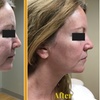 Image 2: Ultherapy Prime Treatment with for Face, Neck and Chest 