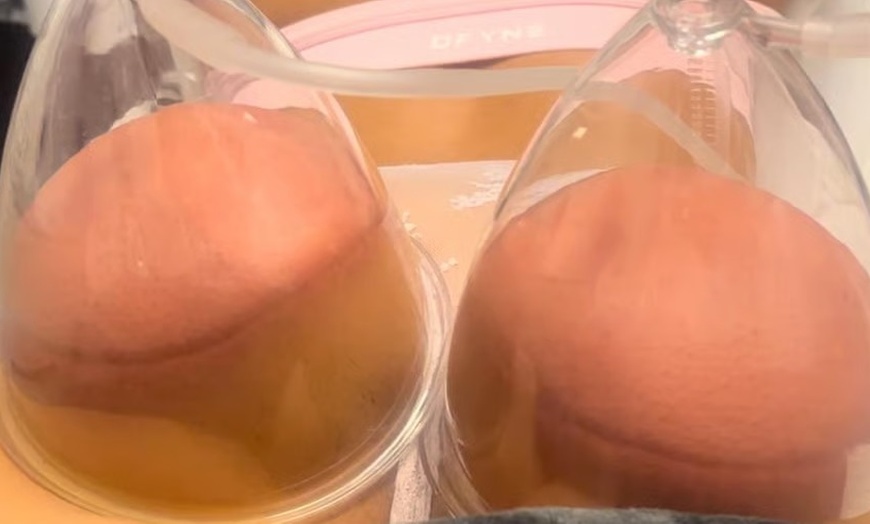 Image 3: Popo-Lift-Vakuum-Behandlung