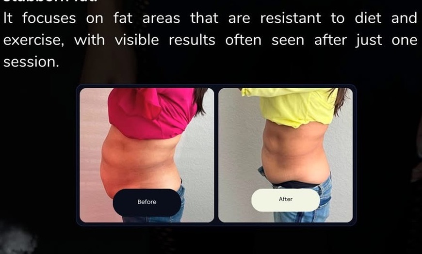 Image 6: Cryoslimming for Stubborn Abdominal Fat: No Surgery, No Downtime