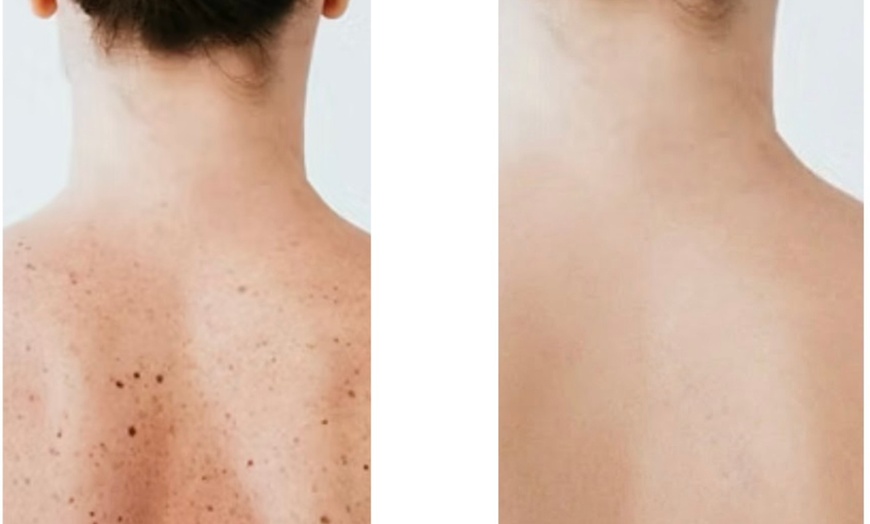 Image 2: Removal of 1, 2, or 3 Skin Tags, Angiomas, Milia, or Age Spots