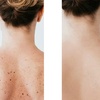 Image 2: Removal of 1, 2, or 3 Skin Tags, Angiomas, Milia, or Age Spots