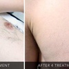 Image 2: Up to 50% Off on Laser Hair Removal at The Glam House Clinic