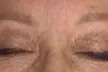 Achieve Ink-Free Skin with Laser by Nicole's Tattoo Removal for All Sizes up to 39% - Second Medium