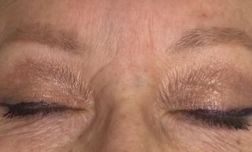 Image 6: Achieve Ink-Free Skin with Laser by Nicole's Tattoo Removal for All Sizes up to 39%