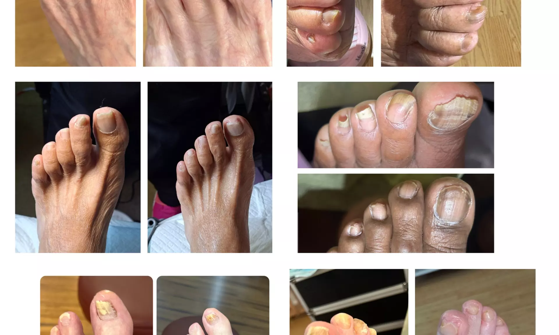 Medical Pedicure, Corn and Callus, Ingrown Toenails, Moisturizer