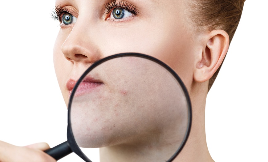 Image 6: Up to 51% Off on Acne Facial at Skin Deep Beauty and Beyond