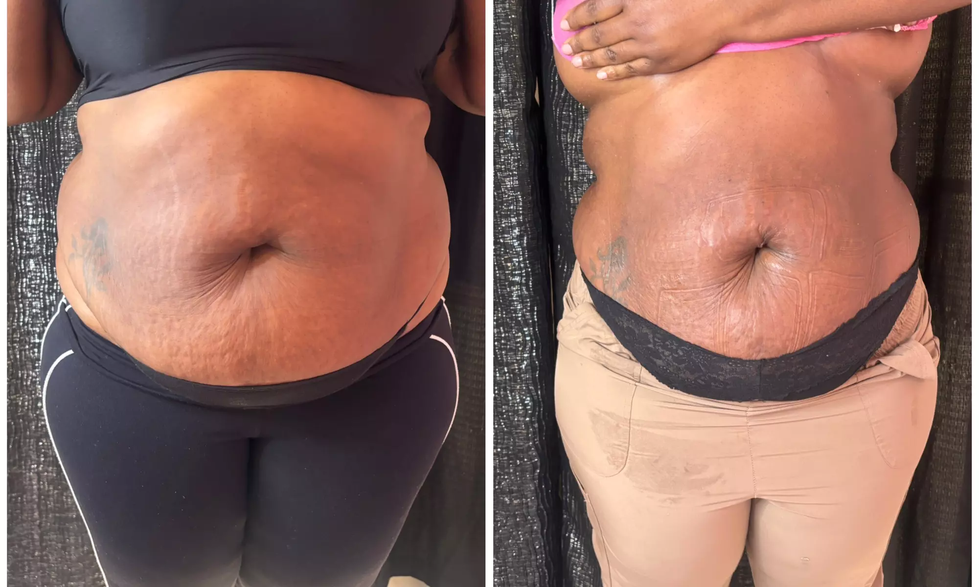 Up to 30% Off on Cavitation at Extreme body sculpting